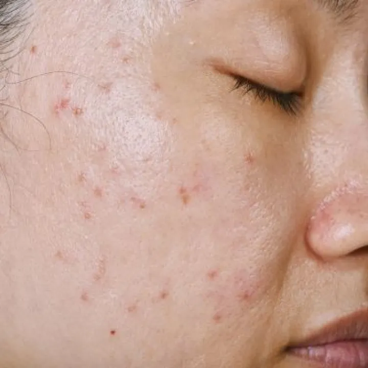 peau grasse avec acné
